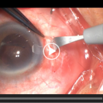 Four-point intraocular lens suspension in treating intraocular lens dislocation