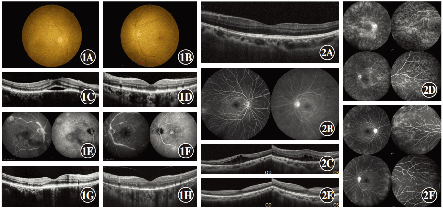 Uveitis complicated with systemic tuberculosis associated with inappropriate adalimumab therapy: two case reports
